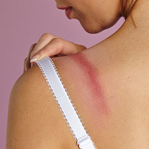 Why do I get rash near my bra area? – Cottonique - Allergy-free Apparel